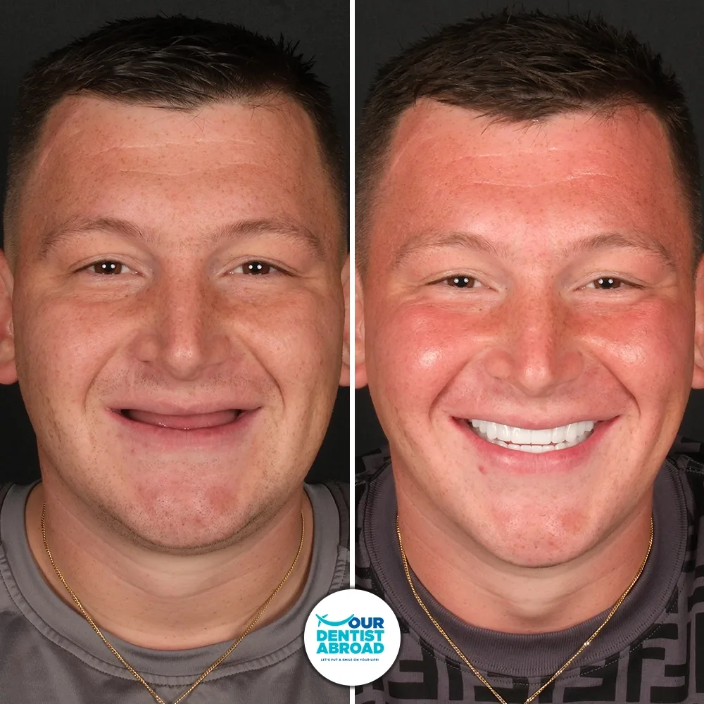 Before and after — Smile Makeover