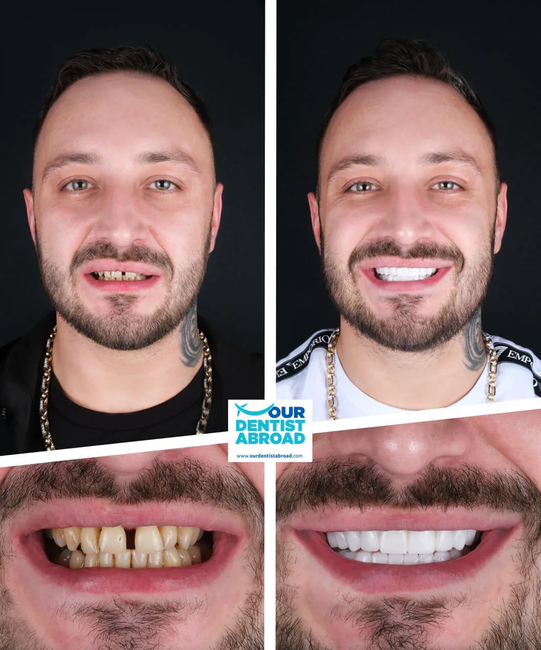 Teeth whitening before and after