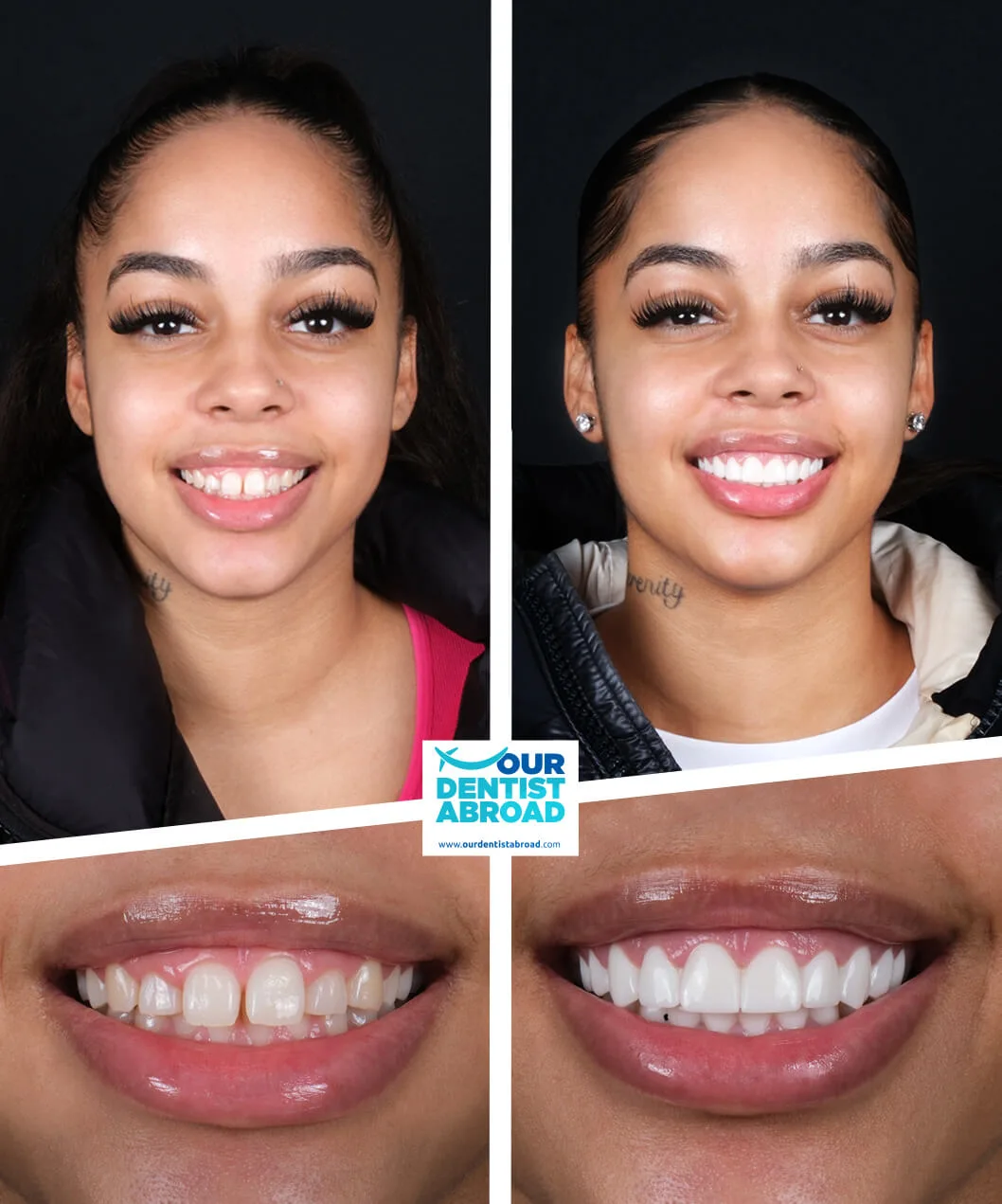 Teeth whitening before and after
