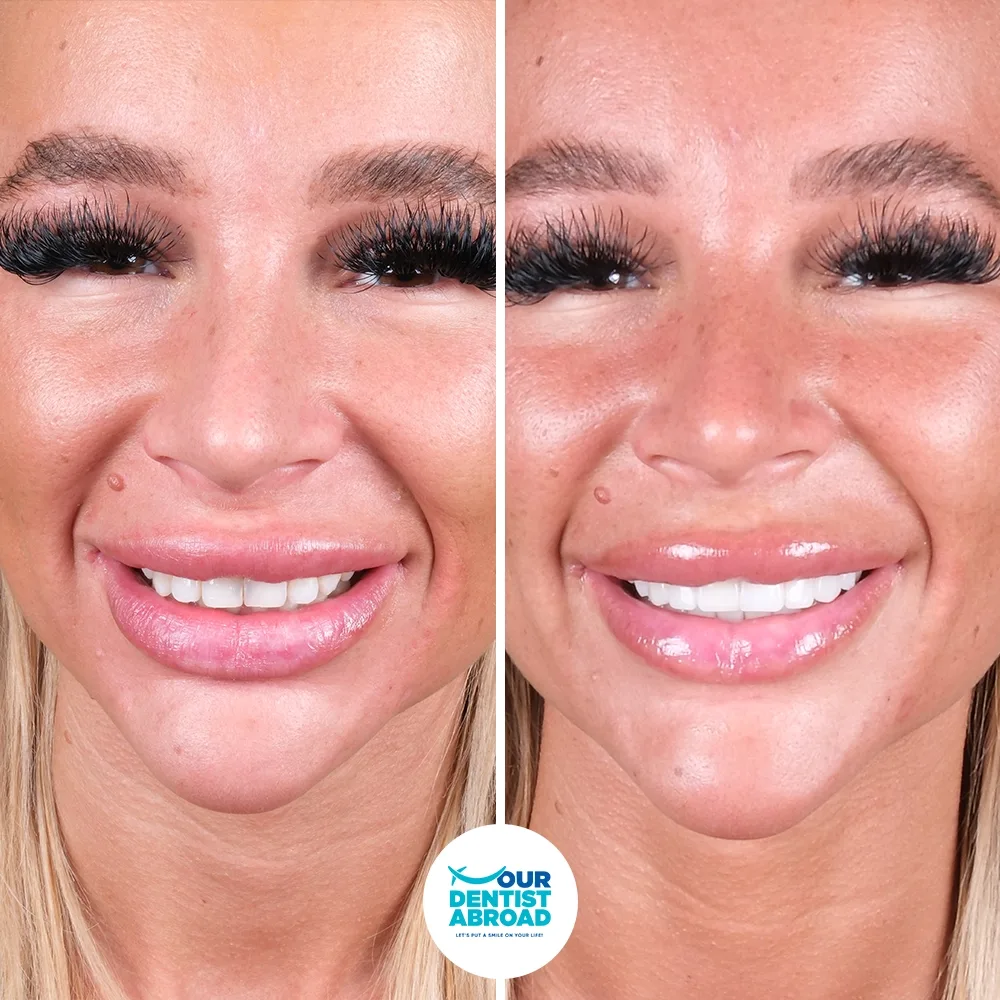 E-max smile before and after