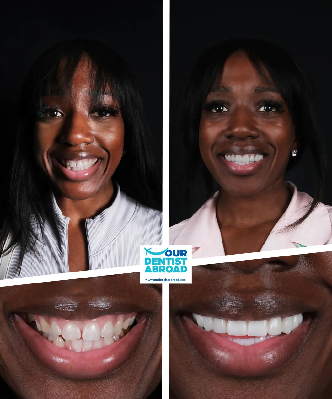 Teeth whitening before and after