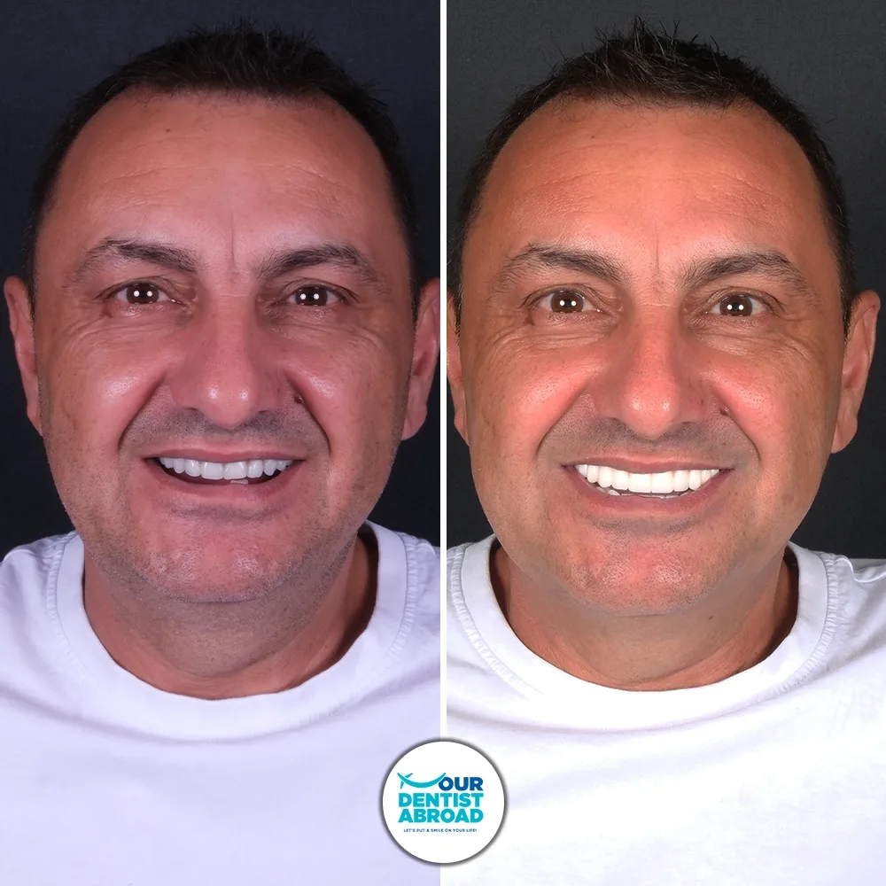 Before and after — Dental Implants