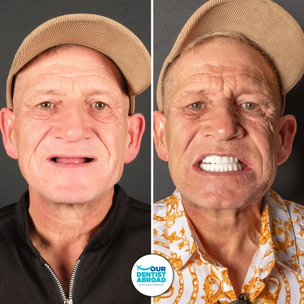 All-on-6 before and after