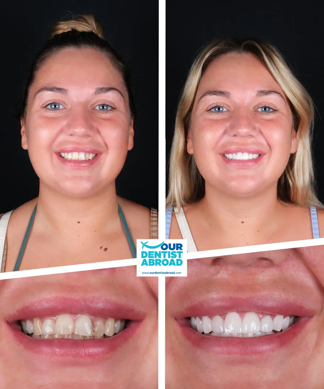 Teeth whitening before and after