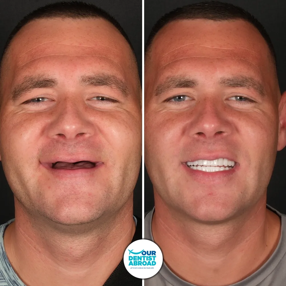 Before and after — E-Max Crown
