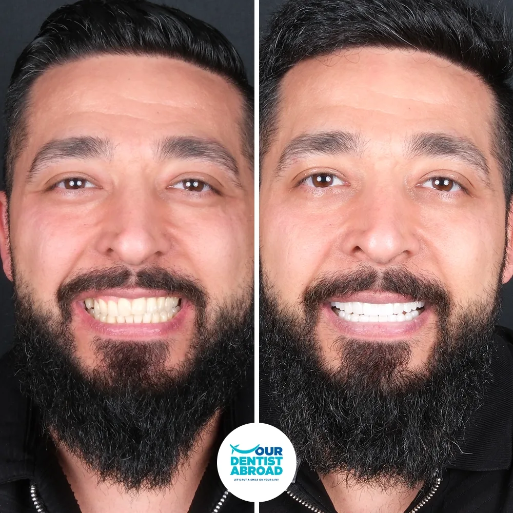 E-max crowns before and after