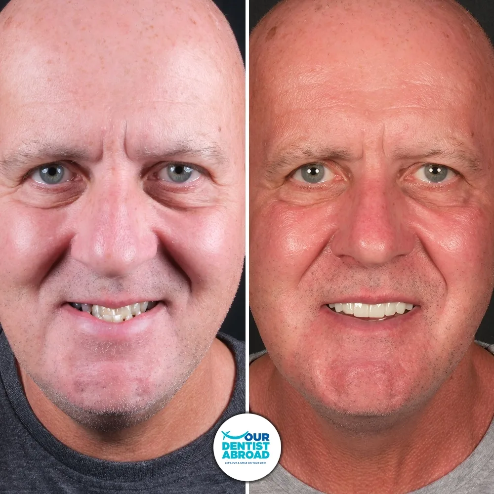 Before and after — Zirconium Crown