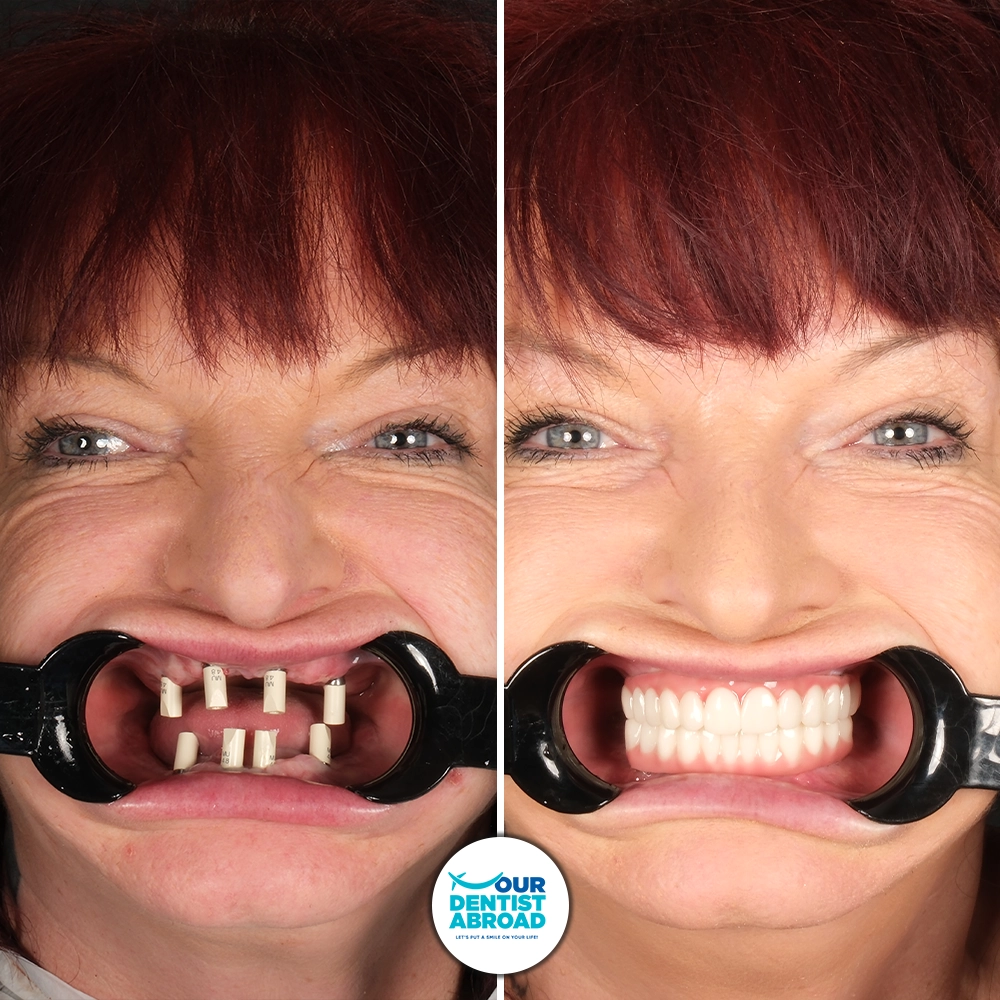Smile Makeover with Implants Before and After