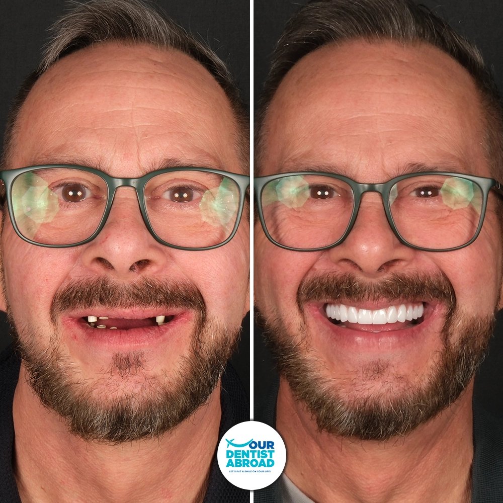 Zirconium Crowns Before and After