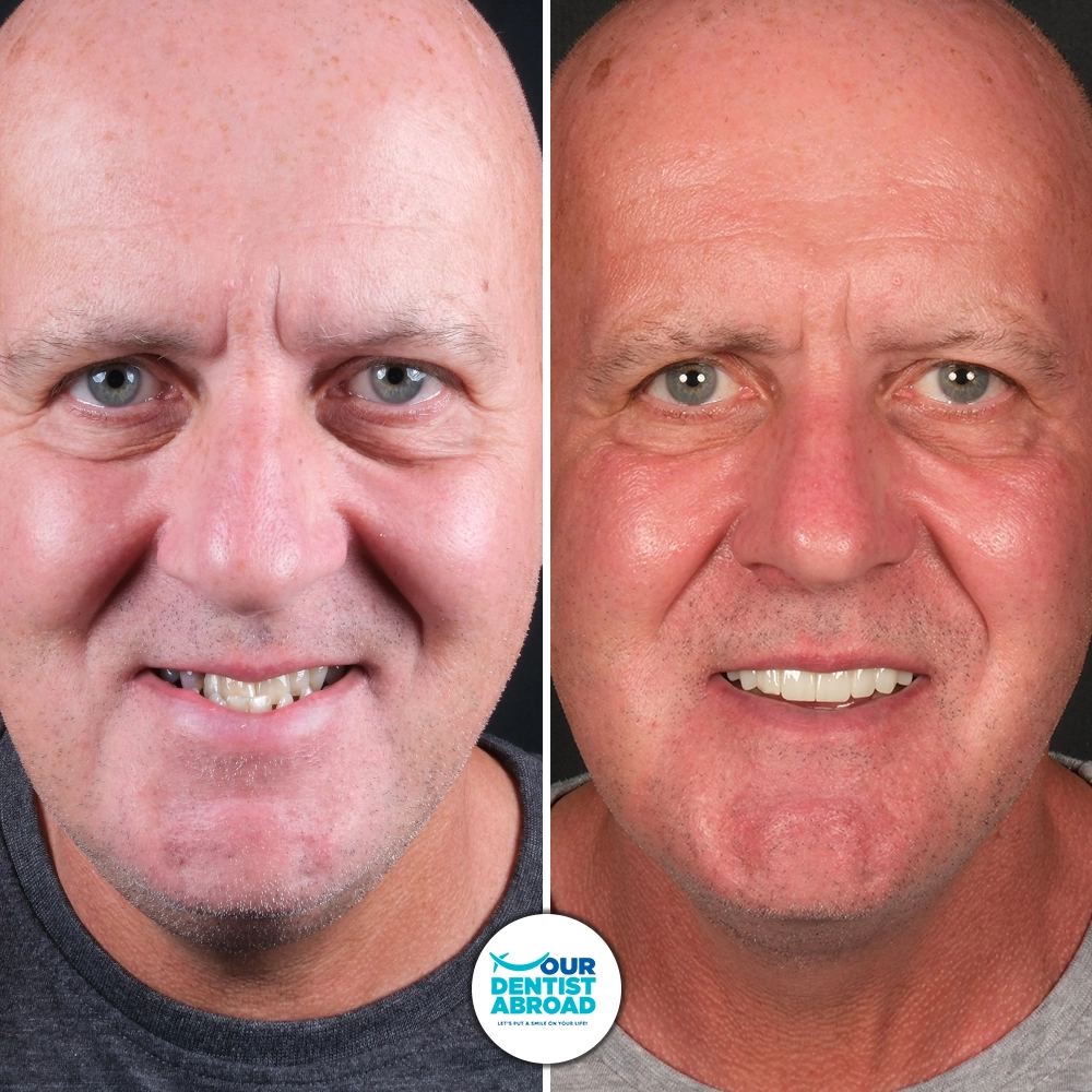 Hollywood Smile Before and After