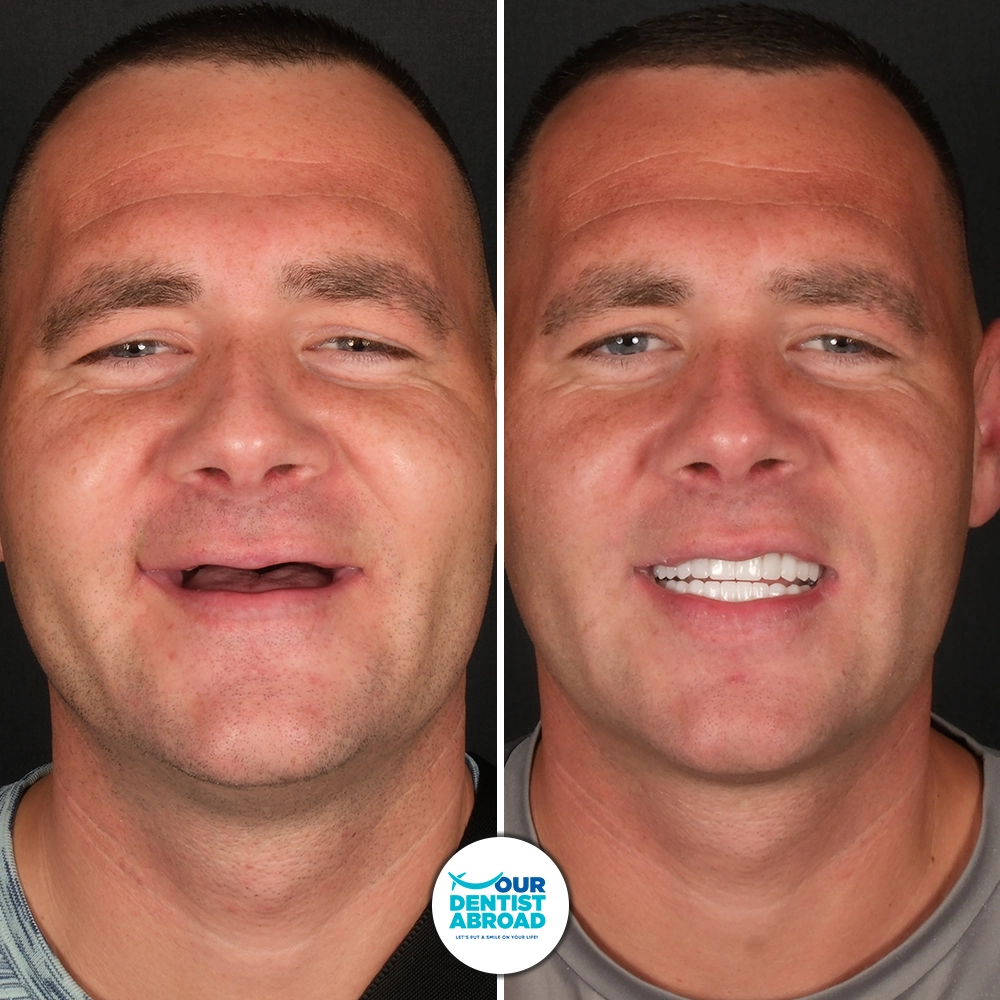 All-on-6 Dental Implants Before and After